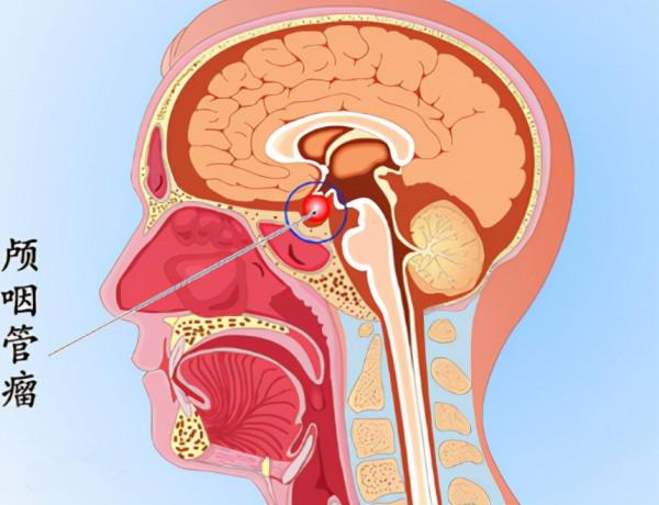神經外科張永力:少兒頭痛、視力下降、長不高等,要警惕顱咽管瘤 神經外科張永力:少兒頭痛、視力下降、長不高等,要警惕顱咽管瘤