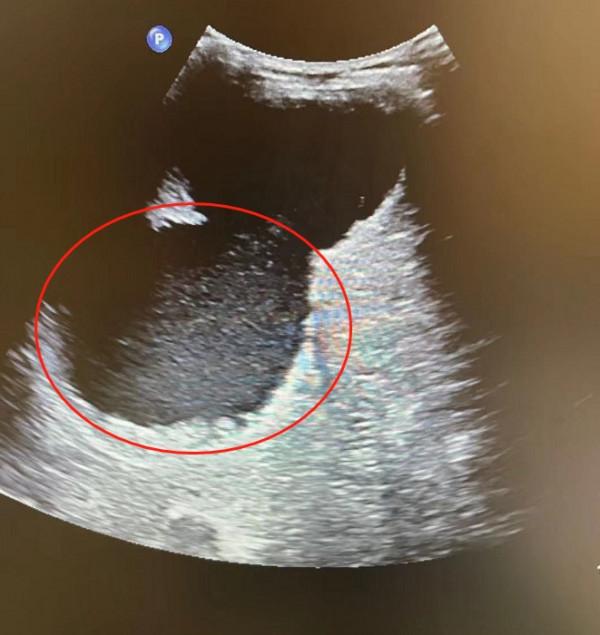 肝上長18釐米巨大囊腫 置管引流5天才排淨 肝上長18釐米巨大囊腫 置管引流5天才排淨
