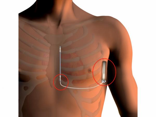 兩個小切口植入除顫器,為重度心衰患者糾正心率不齊 兩個小切口植入除顫器,為重度心衰患者糾正心率不齊