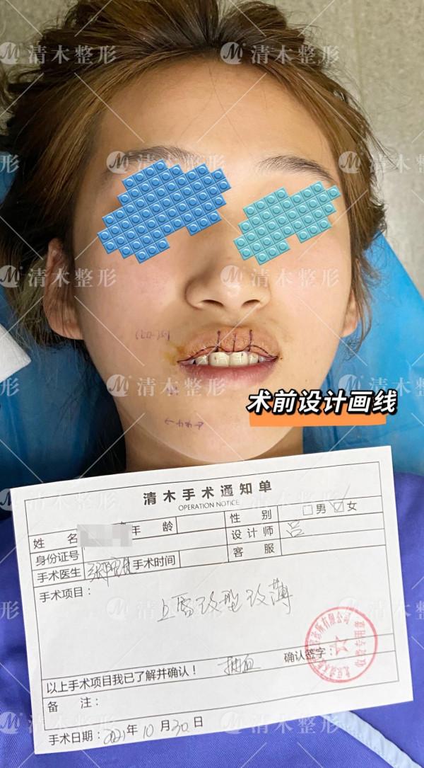 今日分享 | 上唇改薄＋改型