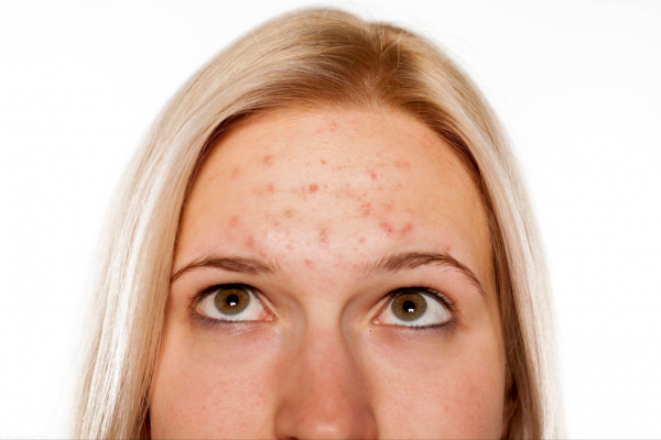 痘痘長在臉上的位置代表什麼?|每天一堂冷知識 痘痘長在臉上的位置代表什麼?|每天一堂冷知識