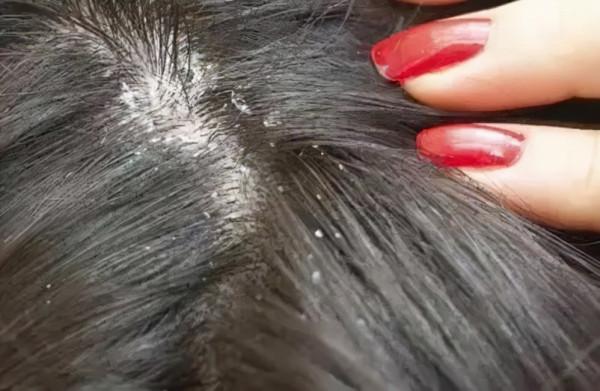 為什麼經常洗頭髮,還有許多頭皮屑?極有可能是這2點被你忽視了 為什麼經常洗頭髮,還有許多頭皮屑?極有可能是這2點被你忽視了