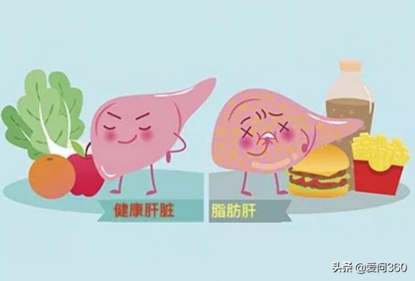 身體若有脂肪肝，一定會有這些表現，得了脂肪肝如何飲食？