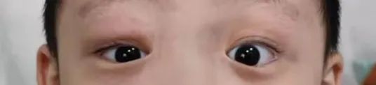 【兒研所兒醫說】孩子眼睛腫，醫生為什麼讓去看耳鼻喉？