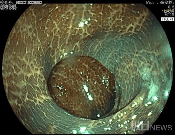 腸子變黑，其實並不罕見！別再一便秘就濫用瀉藥，無異於“飲鴆止渴”