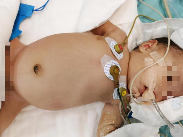大手術，零出血！女嬰膽管擴張至碗口大，手術創七個&OpenCurlyDoubleQuote;世界第一&rdquo;