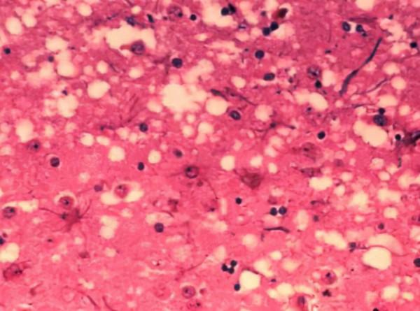 人類為何不敢同類相食?一旦染上致死率100%,揭露人類基因的秘密 人類為何不敢同類相食?一旦染上致死率100%,揭露人類基因的秘密