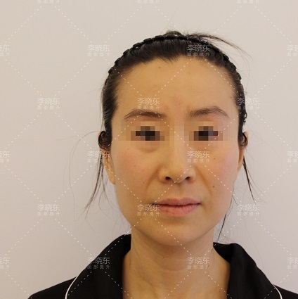 「53歲的趙女士」PSV面部提升術後30天，親身經歷解答大家的疑問