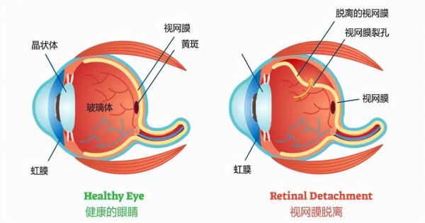 「眼病預警」當眼睛出現這些症狀，要注意了