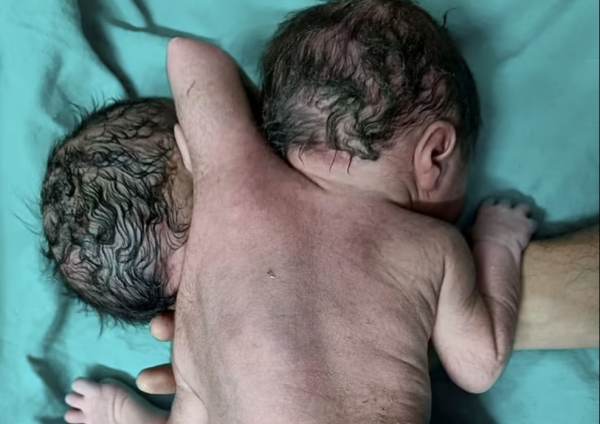 機率僅有百萬分之一！印度女子產下胎兒似“哪吒”，醫生直呼罕見