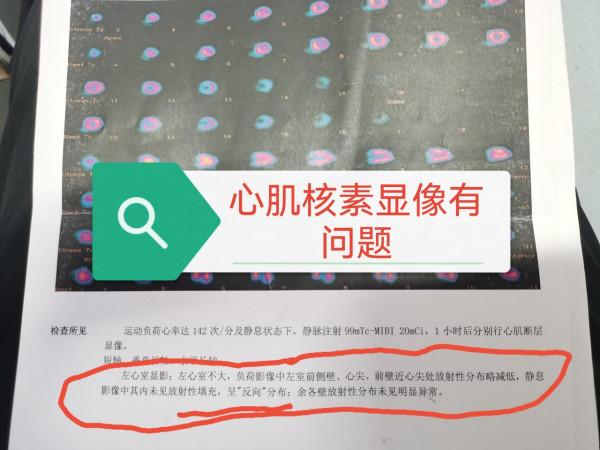 心電圖、心臟彩超、冠脈造影都正常，能排除冠心病嗎？醫生：不能