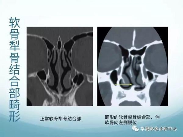 頭頸五官CT斷層解剖圖及常見病影像診斷