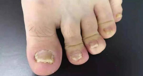 偶買噶!我的指甲為什麼總也治不好?4種甲病要對症治療 偶買噶!我的指甲為什麼總也治不好?4種甲病要對症治療