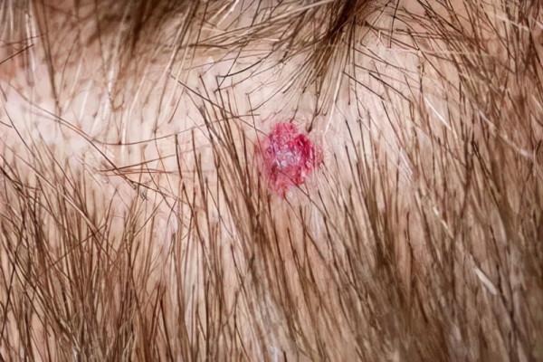 頭皮真菌感染怎麼治療? 頭皮真菌感染怎麼治療?