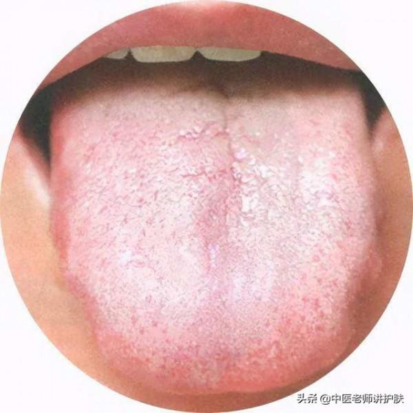 頭髮出油？是“痰溼”漂上來！送你兩個方子，一方化痰，一方生髮