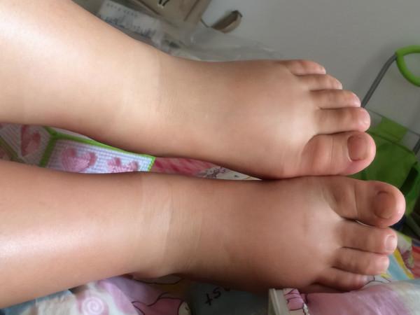 54歲女士泡腳發現腿腫，沒當回事，後來去醫院檢查，結果如何？