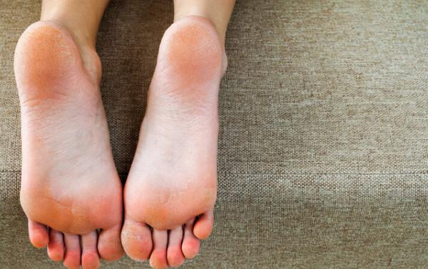 女性想知道自己是否健康，低頭看看腳就知道，如有4個現象要留心