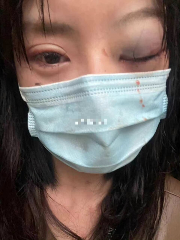 百萬網紅疑遭男友家暴，眼睛青紫滿臉抓痕，傷勢過重讓人認不出