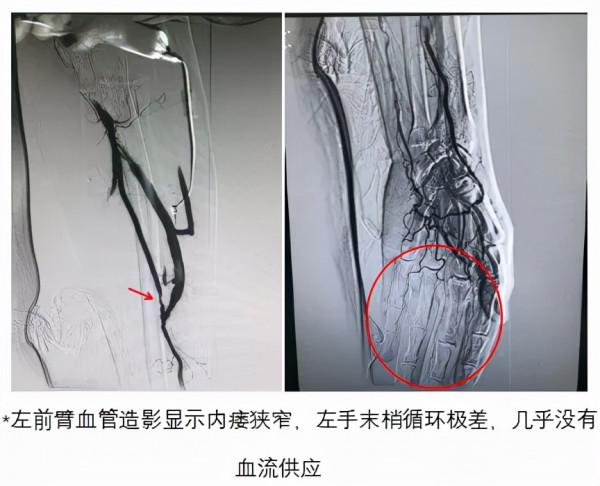 被“偷血的手”——罕見的“竊血綜合徵”