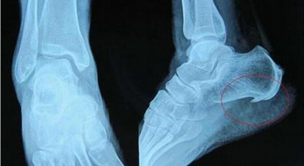 腳後跟疼千萬別忍,可能跟3個疾病有關,儘早就醫才是上策 腳後跟疼千萬別忍,可能跟3個疾病有關,儘早就醫才是上策