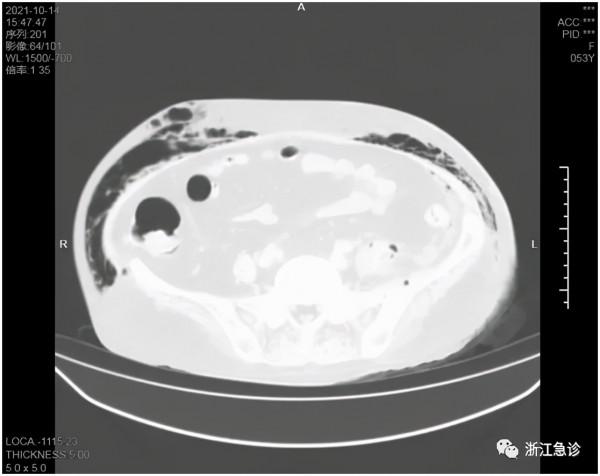 小小面板紅腫，也可能是致命的疾病！這一類皮下感染不要疏忽