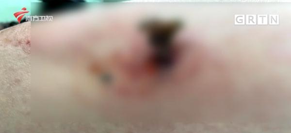 又險又疼!一孕媽走路撞到牆,手裡的魚骨還刺入大腿…… 又險又疼!一孕媽走路撞到牆,手裡的魚骨還刺入大腿……