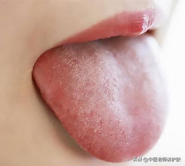 黃褐斑治療一年無果還加重，巧用中藥湯劑，月餘時間斑塊明顯減少