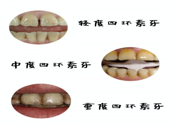 速查藥箱！這8款退燒藥被登出！副作用很多，千萬別用了