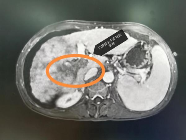 晚期肝癌的介入治療