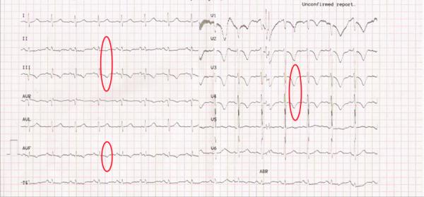 心電圖T波改變是怎麼回事兒?就是冠心病嗎? 心電圖T波改變是怎麼回事兒?就是冠心病嗎?