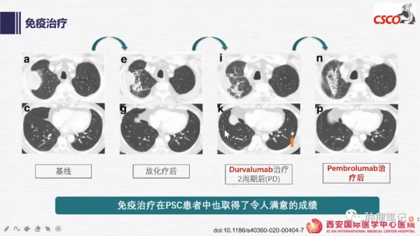 肺肉瘤樣癌治療進展