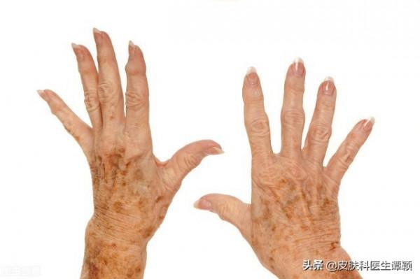 面板科醫生和你聊聊:老年斑/脂溢性角化可以如何治療? 面板科醫生和你聊聊:老年斑/脂溢性角化可以如何治療?