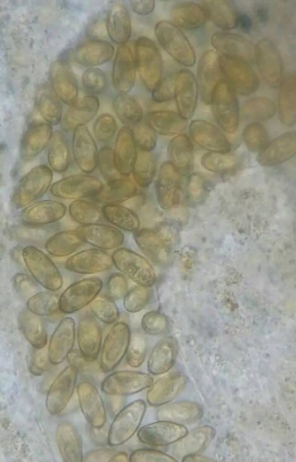 男子春節後腹痛發熱，檢查肝臟&OpenCurlyDoubleQuote;被掏空了&rdquo;，切開後醫生頭皮發麻