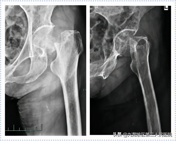 22張高畫質X線片!帶你看清胯骨骨折手術前後對比 22張高畫質X線片!帶你看清胯骨骨折手術前後對比
