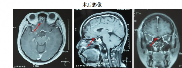 內鏡微創手術&mdash;&mdash;嗅溝腦膜瘤患者的福音
