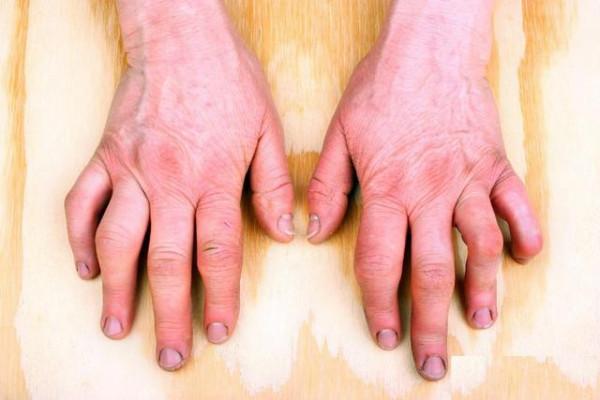 早上起床後，雙手發脹，五指握不攏，但等會又好了，是什麼原因？