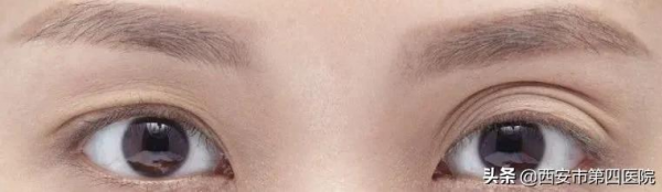 #安心變美課堂##我的安心變美推薦# 眼皮越來越松，怎麼辦？