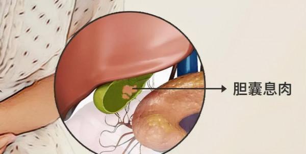 膽囊息肉——瞭解它，才能知道怎麼治療它