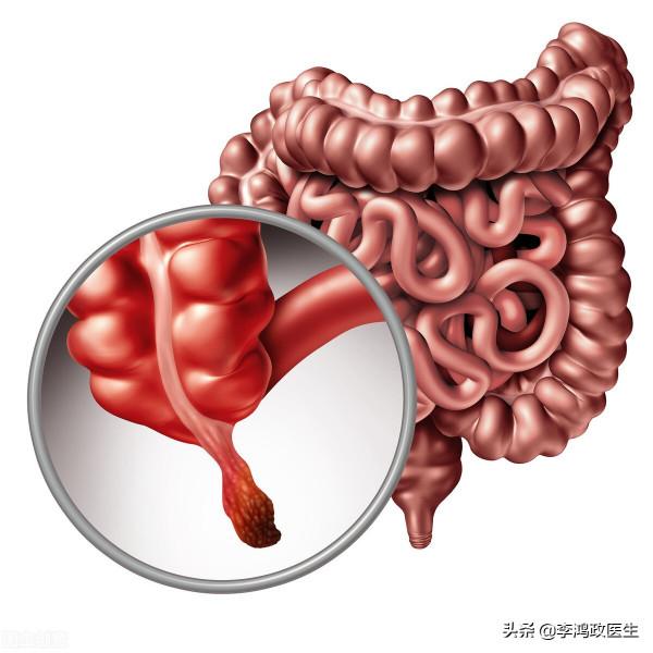 男子腹痛,以為闌尾炎,直到出現口腔潰瘍才發現闌尾切錯了 男子腹痛,以為闌尾炎,直到出現口腔潰瘍才發現闌尾切錯了