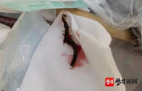 睡夢中,長約5cm的蜈蚣鑽進女士耳朵裡,還亂竄 睡夢中,長約5cm的蜈蚣鑽進女士耳朵裡,還亂竄