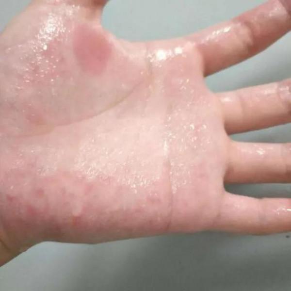 花季少女雙手出汗如流水，多到能泡溼作業本