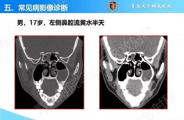 頭頸五官CT斷層解剖圖及常見病影像診斷