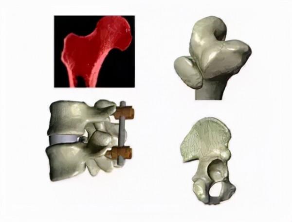 人體組織三維建模技術與有限元分析 人體組織三維建模技術與有限元分析