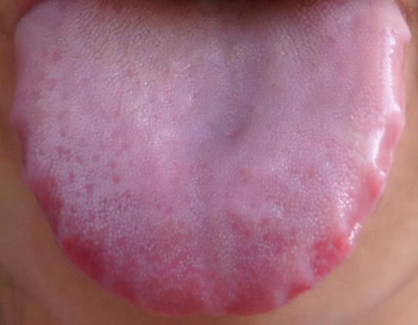 脾胃不好，舌苔白厚有齒痕、舌頭有裂痕，該怎麼調理？