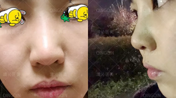 鼻子大變樣,她只用了一個月 鼻子大變樣,她只用了一個月