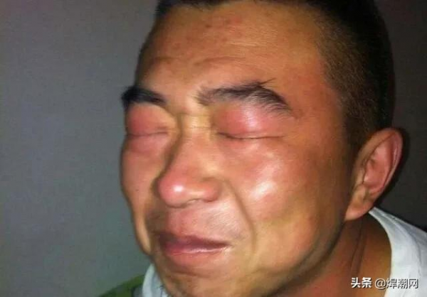 電焊打了眼睛，最好、最快、最方便的辦法是什麼？