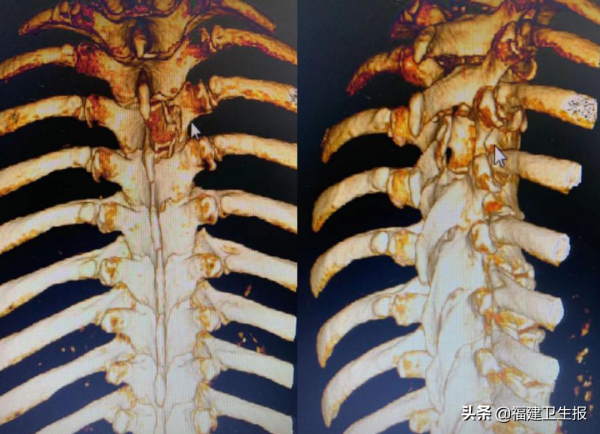 全球首例！福建省立醫院徐傑團隊創新手術為七旬老人精準拆“彈”