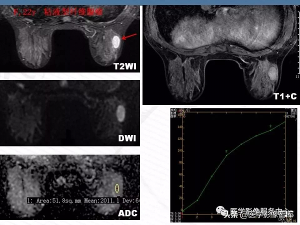 乳腺T2WI高訊號腫瘤病變的診斷思路 乳腺T2WI高訊號腫瘤病變的診斷思路