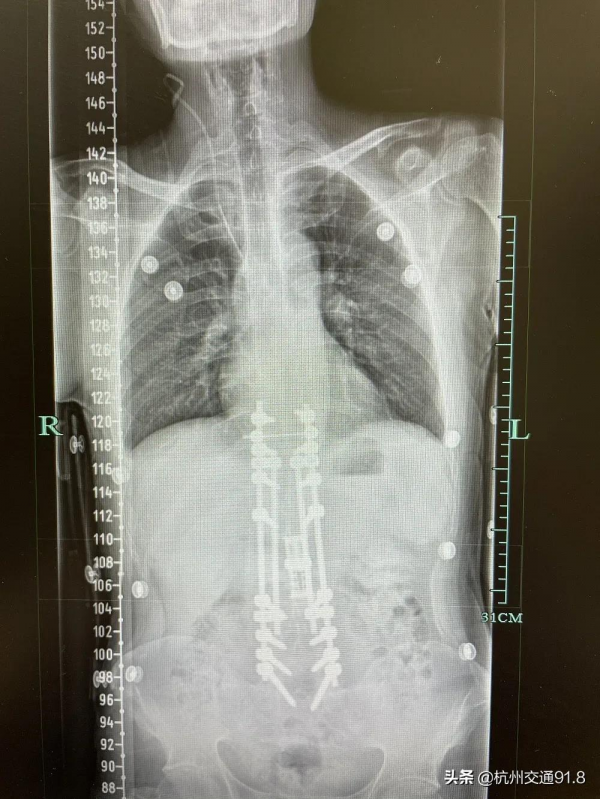 三胎爸爸腰“斷了”，專家說：這種病會遺傳，出現以下症狀要注意