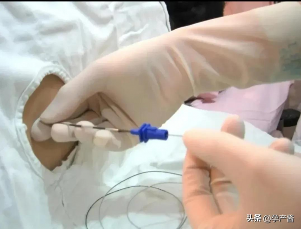 第一篇《我的剖腹產日記》:醫生按肚子按到我肋骨,我直接飈淚 第一篇《我的剖腹產日記》:醫生按肚子按到我肋骨,我直接飈淚